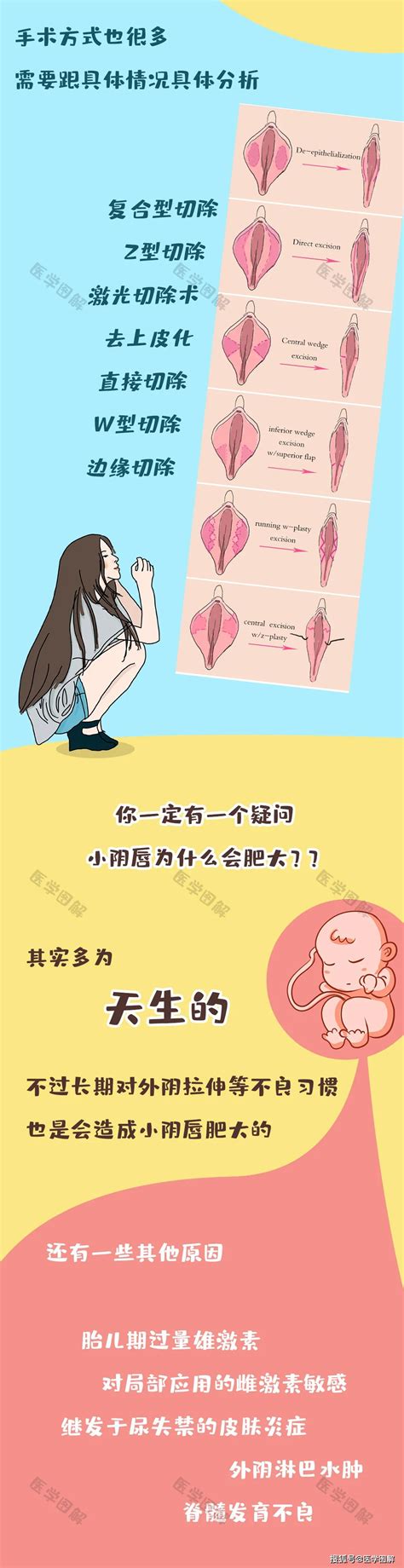 白虎型|原来女性私处还有这么多型？这种形状一定要当心！丨医学图解